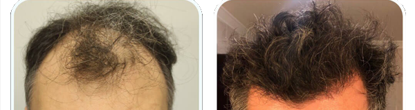 DHI Hair Transplant Method - VivaEst Hair Tarnsplant Antalya